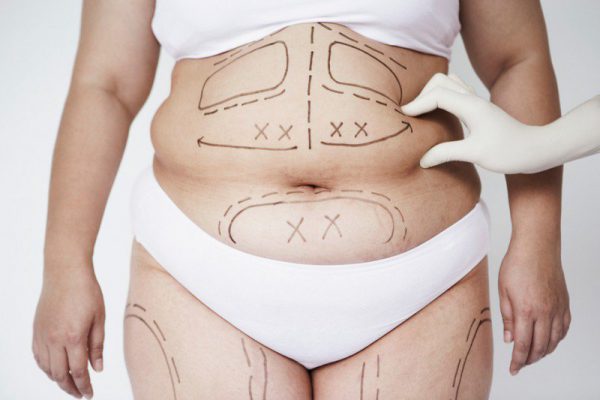 Có nên phẫu thuật giảm mỡ bụng sau sinh không?