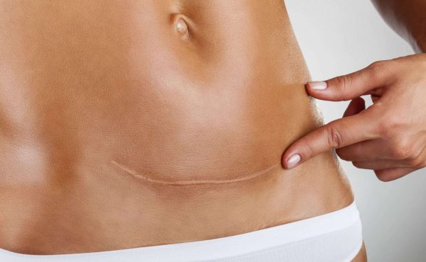 Có nên giảm mỡ bụng sau sinh mổ?