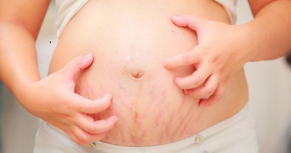 Làm sao để không rạn da khi mang thai, mẹ bầu đã biết chưa?