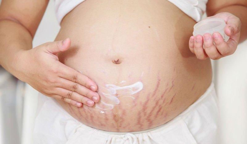 Mách mẹ tuyệt chiêu phòng chống rạn da khi mang thai