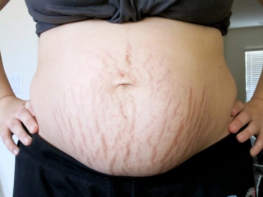 5 cách trị rạn da khi mang thai tại nhà bằng nguyên liệu tự nhiên