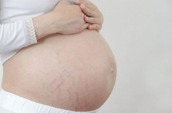 Những nguyên nhân rạn da khi mang thai mẹ cần để ý