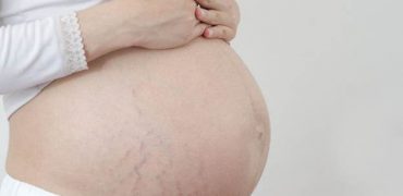 Bật mí cách hạn chế rạn da khi mang thai mẹ bầu nên biết