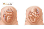 Dấu hiệu chuyển dạ của thai ngôi mông